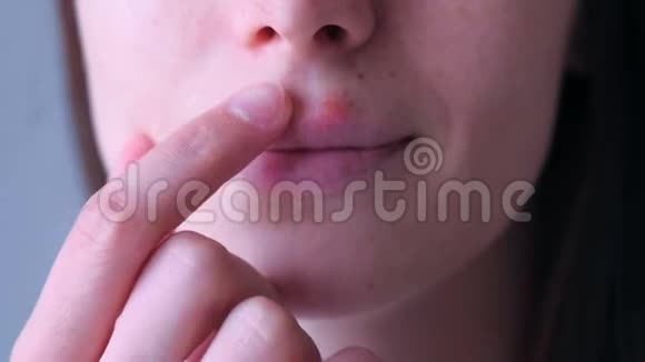 人嘴唇上的疱疹病毒女人碰唇口疱疹疮特写视频的预览图