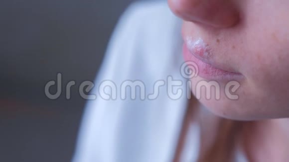 人嘴唇上的疱疹病毒唇口疱疹疮伴软膏的妇女视频的预览图