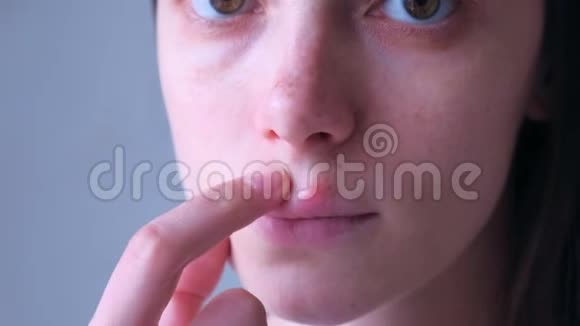 人嘴唇上的疱疹病毒上唇疱疹疮的女人视频的预览图