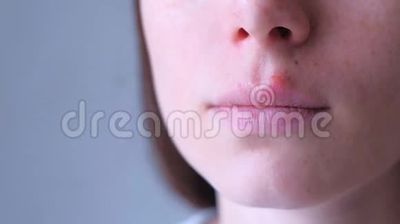 人嘴唇上的疱疹病毒唇口疱疹性咽峡炎女特写视频的预览图