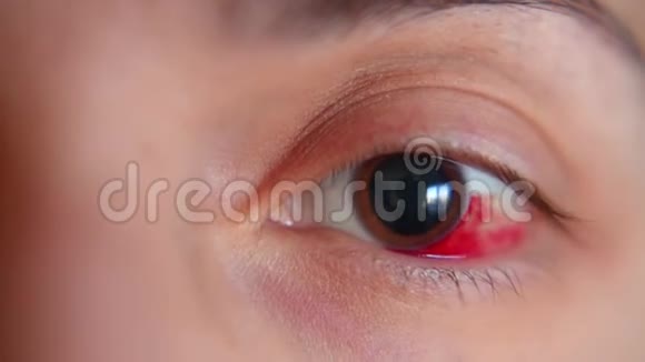 女孩眼中的出血角膜的磨损宏观视频的预览图