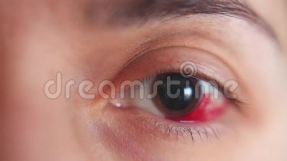 女孩眼中的出血角膜的磨损宏观视频的预览图