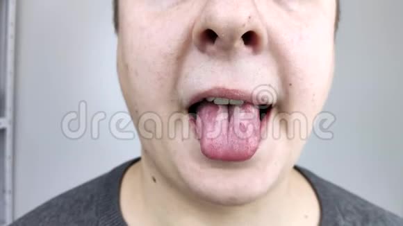舌头上有白豆腐医生或胃肠医生检查法力舌头病人口腔卫生或症状不佳视频的预览图