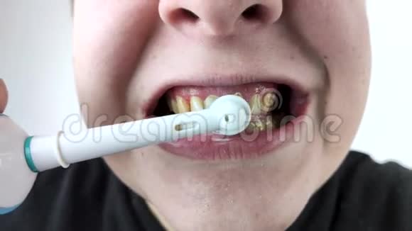 牙龈出血和发炎的情况密切男人用电刷刷牙牙龈出血视频的预览图