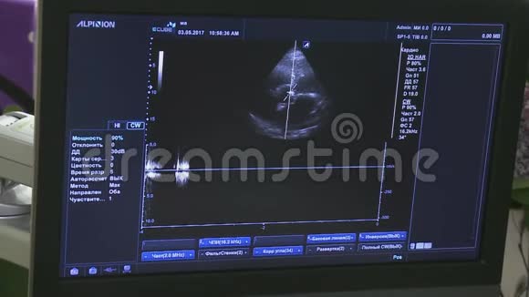医学超声扫描心脏超声心动图视频的预览图