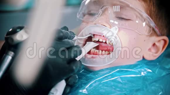 一个牙齿受损的小男孩在牙科诊所用一个张开的护嘴清洁牙齿视频的预览图