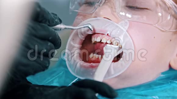 一个戴防护眼镜的小男孩在现代牙科中进行牙齿清洁治疗用一个视频的预览图