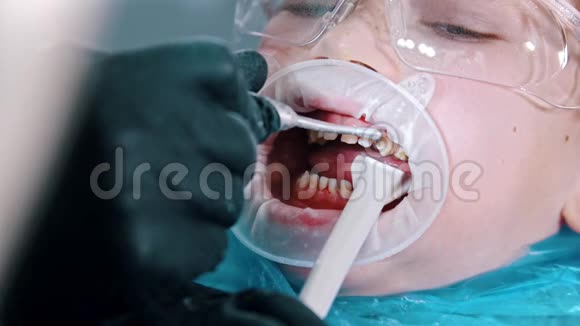 一个戴防护眼镜的男孩在牙科中进行牙齿清洁治疗用吸管收集多余的水视频的预览图