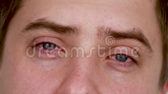 特写蓝男红眼睛结膜炎眼疲劳眼卫生不当红毛细血管形成的后果视频的预览图