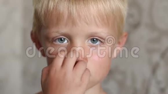 儿童面部的特写脸部和鼻子被晒伤太阳在燃烧视频的预览图