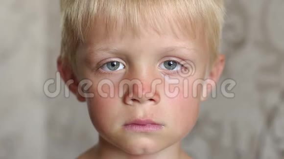 儿童面部的特写脸部和鼻子被晒伤太阳在燃烧视频的预览图