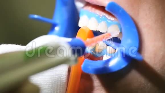 牙科清洁工具要美白视频的预览图