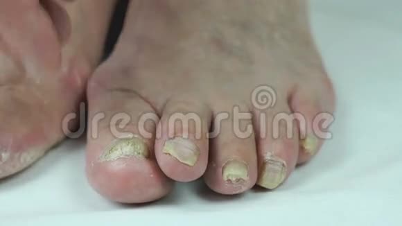 脚趾甲真菌感染的女人视频的预览图