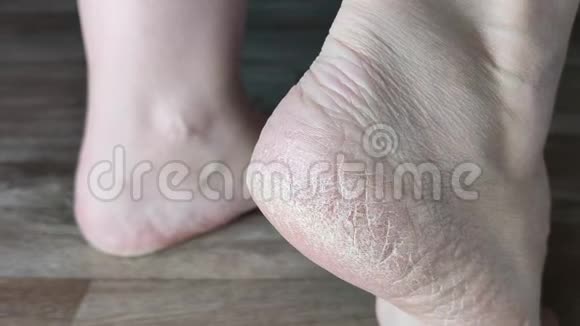 白色女足特写镜头皮肤干燥健康问题需要修脚视频的预览图