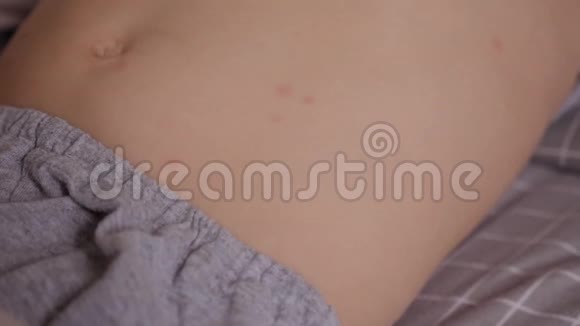 一个小孩皮肤上水痘形成的红色粉刺和水泡视频的预览图