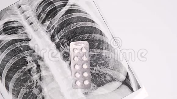白色背景肺炎和支气管炎水泡中的荧光x光和不同药丸视频的预览图