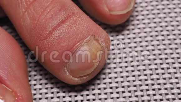 指甲溶液与刷子的应用真菌引起的指甲感染视频的预览图