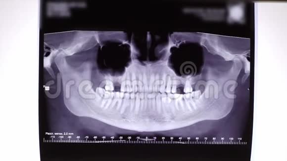 牙齿和下巴的X线片视频的预览图