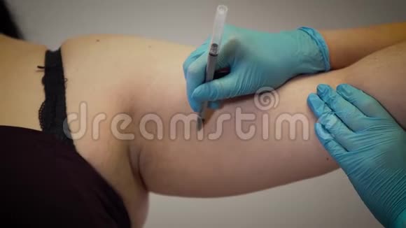 整形外科医生在肥胖的白人女性手上画线肥胖病人准备整容手术吸脂视频的预览图