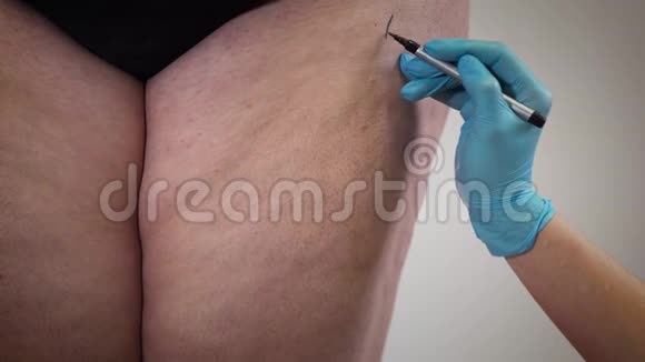 女性白种人戴着医用手套在胖女人腿上画线整形外科医生为整容病人做准备视频的预览图