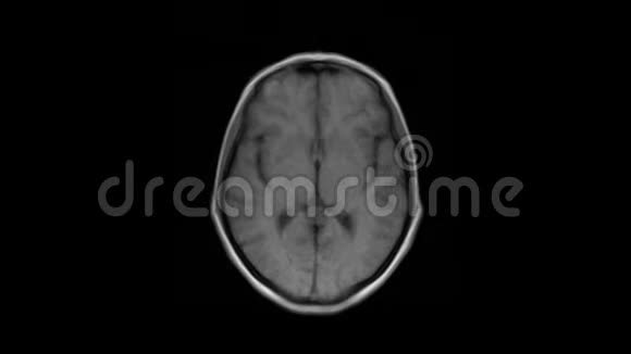 纯化的MRI脑头部扫描和肿瘤检测诊断医疗工具视频的预览图