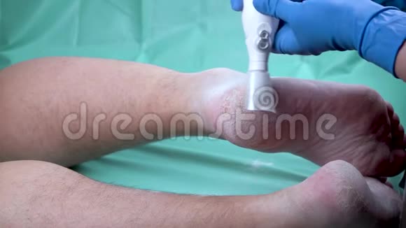 愈伤组织剥离使用专业修脚工具用力去除脚上的痂皮视频的预览图