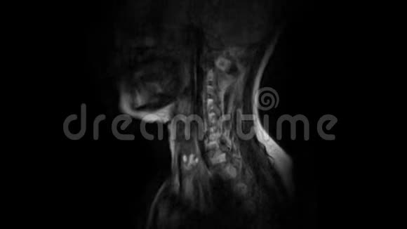 颈椎MRI的净化突起和疝的检测视频的预览图
