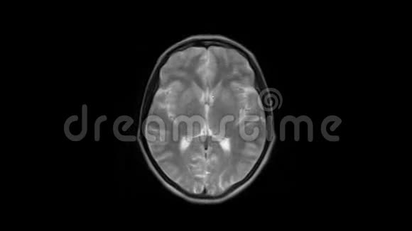 脑MRI头部扫描和肿瘤检测诊断医疗工具视频的预览图