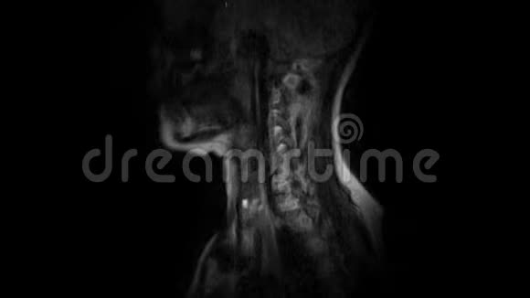 颈椎MRI检查突出和疝视频的预览图