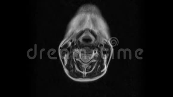 颈椎MRI的净化突起和疝的检测视频的预览图