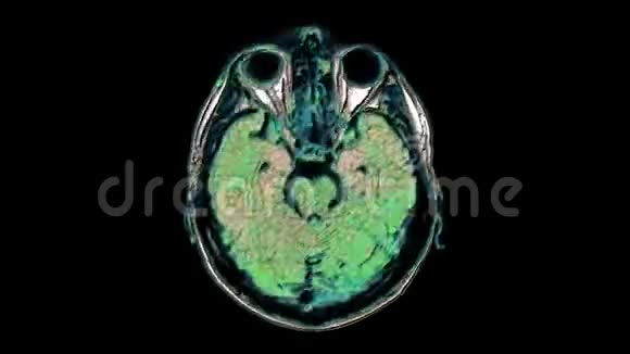 大量的彩色MRI扫描大脑和头部以检测肿瘤诊断医疗工具视频的预览图