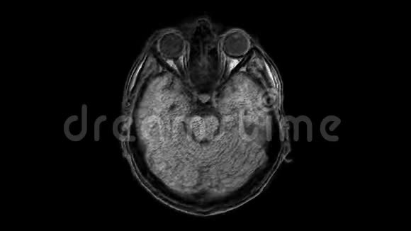 脑和头部的大量MRI扫描以检测肿瘤诊断医疗工具视频的预览图