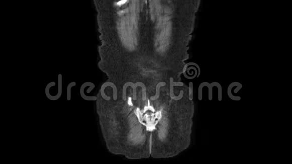腹腔胃肠道膀胱的MRI视频的预览图