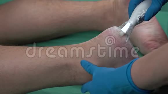 愈伤组织剥离使用专业修脚工具去除坚硬的脚上的角质视频的预览图