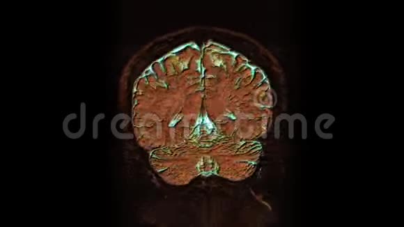 大量彩色MRI扫描大脑和头部以检测肿瘤诊断医疗工具视频的预览图
