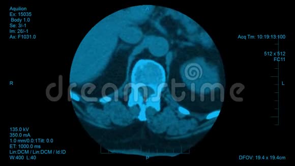 脊柱计算机断层扫描结果可视化脊柱椎间盘的水平筛查视频的预览图
