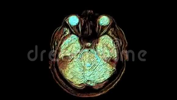 大量彩色MRI扫描大脑和头部以检测肿瘤诊断医疗工具视频的预览图