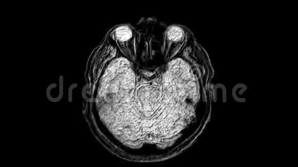 脑和头部的大量MRI扫描以检测肿瘤诊断医疗工具视频的预览图