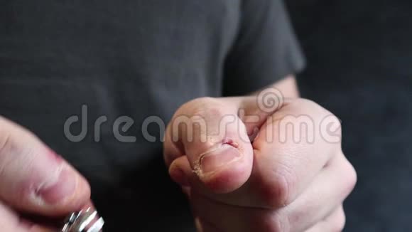 一个男人在钳子特写的帮助下仔细地剪指甲成年人选择丑陋的指甲咬你的坏习惯视频的预览图