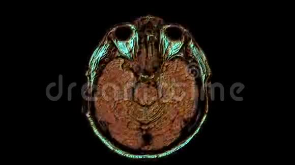 大量的彩色MRI扫描大脑和头部以检测肿瘤诊断医疗工具视频的预览图