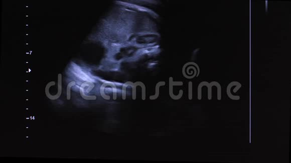子宫内未出生婴儿的超声波图像视频的预览图