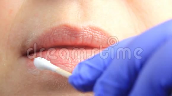 戴手套的医生在患疱疹疱疹的女孩的嘴唇上涂上棉签唇部治疗慢动作视频的预览图