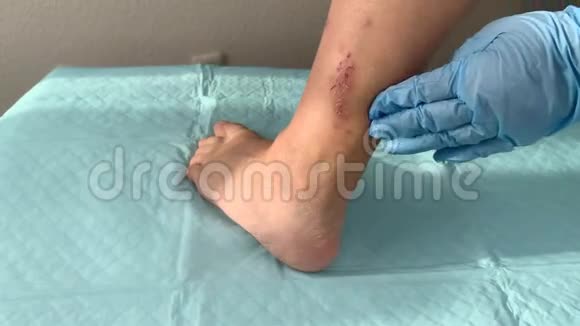 医生护士戴蓝色手套用药物触诊女性腿上的伤口伤口处理4k慢镜头拍摄视频的预览图