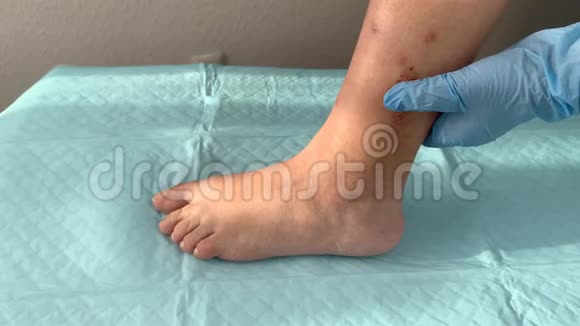 医生护士戴着蓝色手套触诊一名妇女腿部伤口医学概念视频的预览图