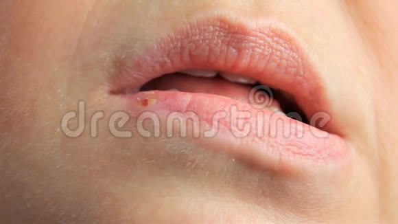 女人嘴唇上有疱疹疱疹唇部治疗慢镜头拍摄复制空间视频的预览图