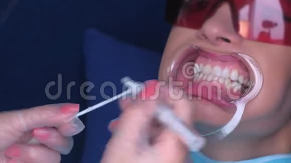 牙科用凝胶剂对女性患者牙齿进行LED美白视频的预览图