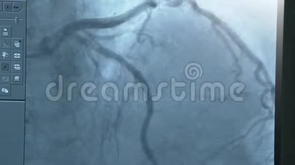 血管造影显示的脉脉和动脉视频的预览图