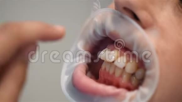 牙医修理Braces视频的预览图
