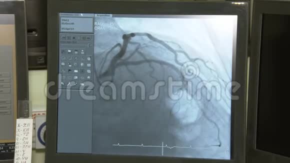 冠状动脉造影移动心脏和血液设备屏幕视频的预览图