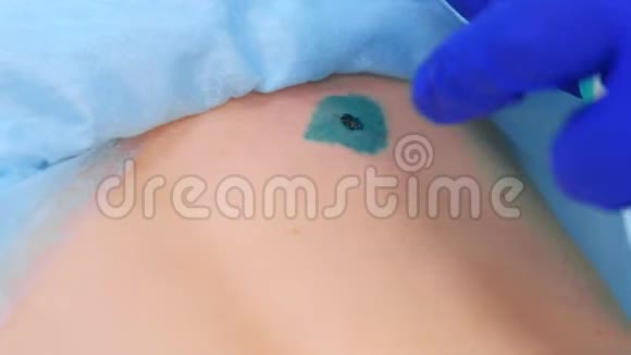 外科医生在取出痣后用石膏封闭病人背部双手特写视频的预览图